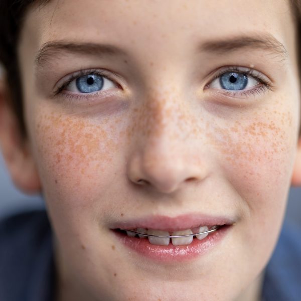 Close-up portrait of a teenage boy with blue eyes and a blue shirt, a child smiling and looking at the camera with freckles on his skin and braces on his teeth.